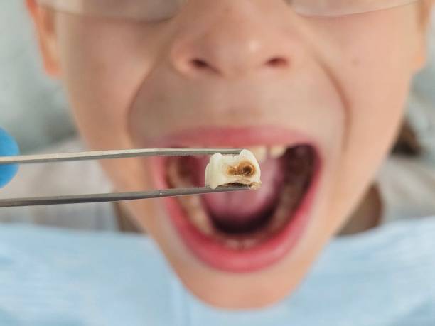 Best Broken or Chipped Tooth Repair in St Paul, MO